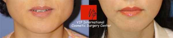 Facial Bone Surgery - Челюстно-лицевая хирургия, уменьшение квадратной челюсти