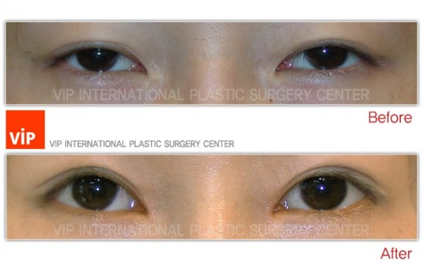 Eye Surgery - Создание &#034;двойного века&#034; и Коррекция птоза