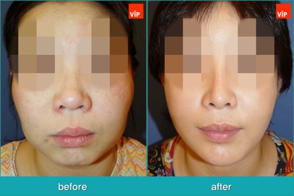 Nose Surgery, Facial Bone Surgery, Stem Cell Fat Graft - Ринопластика с ипользованием реберного хряща, лицево-челюстная хирургия, липофилинг стволовыми клетками, V-линия