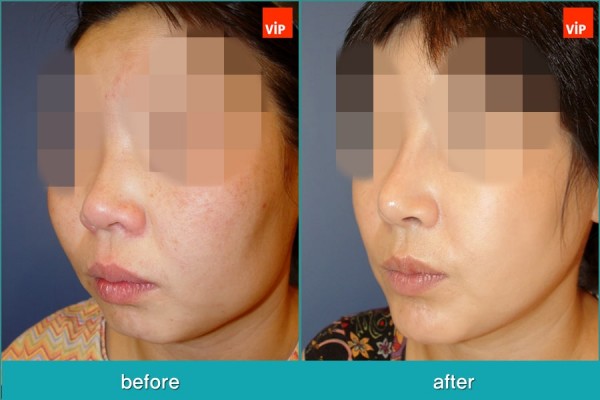 Nose Surgery, Facial Bone Surgery, Stem Cell Fat Graft - Ринопластика с ипользованием реберного хряща, лицево-челюстная хирургия, липофилинг стволовыми клетками, V-линия