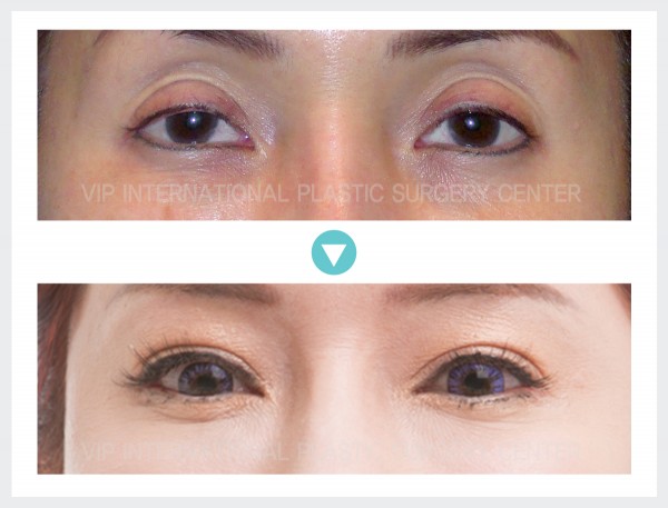 Eye Surgery, Stem Cell Fat Graft - Ptosis Correction, Upper Eyelid Fat graft