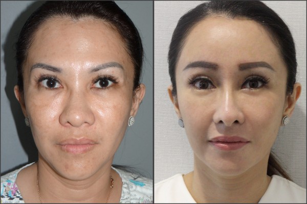 Nose Surgery, Eye Surgery, Face Lift, Stem Cell Fat Graft - Rib cartilage Rhinoplasty, Endoscopic Forehead Lift, Fat graft, Lateral Canthoplasty