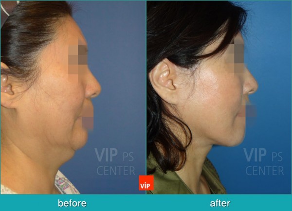 Face Lift - Подтяжка шеи методом High SMAS до и после