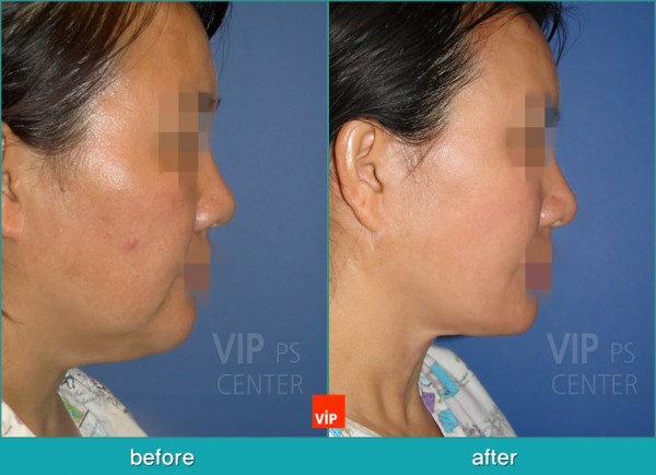 Face Lift - Подтяжка шеи методом High SMAS до и после