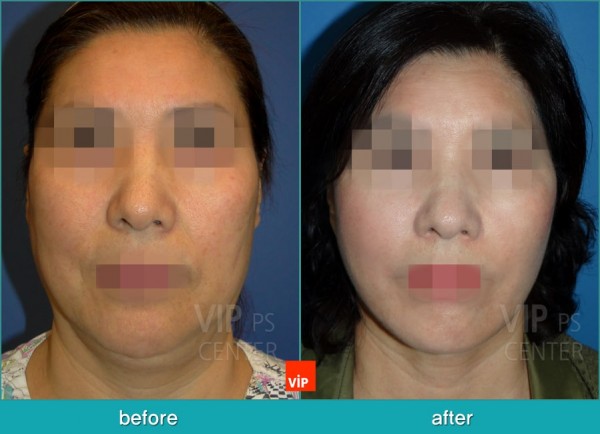 Face Lift - Подтяжка шеи методом High SMAS до и после
