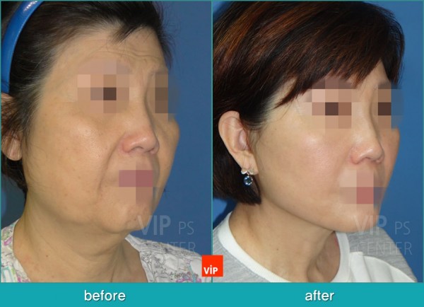 Face Lift - Подтяжка шеи методом High SMAS до и после