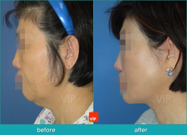 Face Lift - Подтяжка шеи методом High SMAS до и после