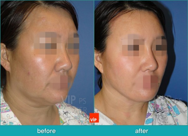 Face Lift - Подтяжка шеи методом High SMAS до и после