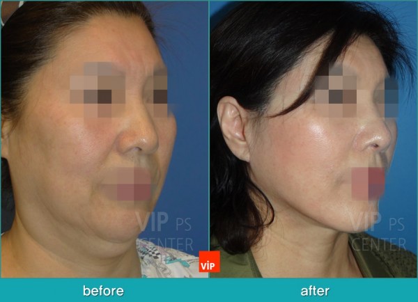 Face Lift - Подтяжка шеи методом High SMAS до и после
