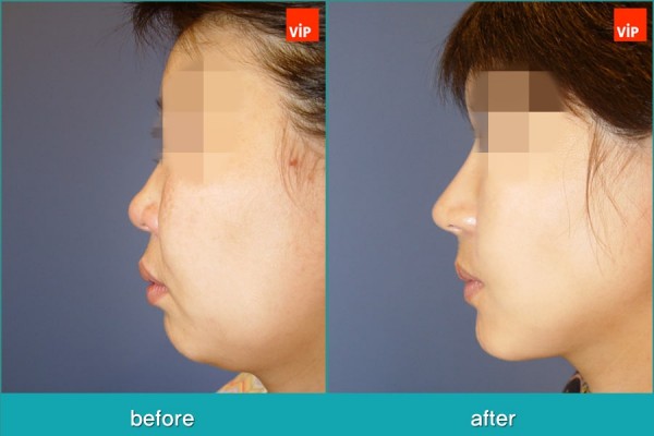 Nose Surgery, Facial Bone Surgery, Stem Cell Fat Graft - Ринопластика с ипользованием реберного хряща, лицево-челюстная хирургия, липофилинг стволовыми клетками, V-линия