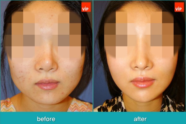Nose Surgery, Facial Bone Surgery - Контурная хирургия лица, V-линия - уменьшение подбородка, гармоничная ринопластика