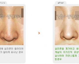 Revision rhinoplasty - Silicone/ear cartilage showing nose