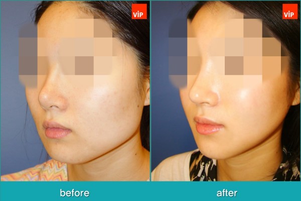 Nose Surgery, Facial Bone Surgery - Контурная хирургия лица, V-линия - уменьшение подбородка, гармоничная ринопластика