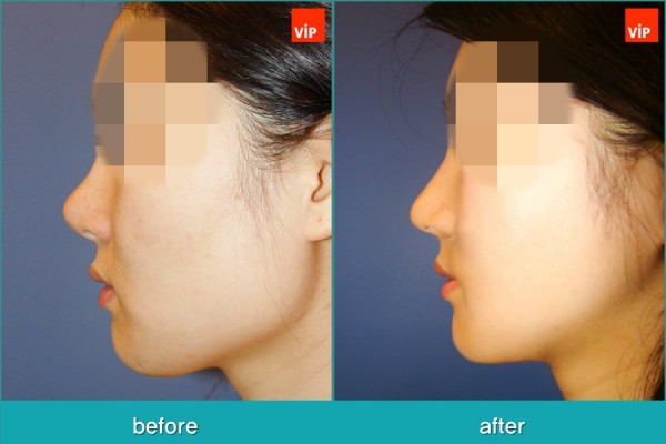 Nose Surgery, Facial Bone Surgery - Контурная хирургия лица, V-линия - уменьшение подбородка, гармоничная ринопластика