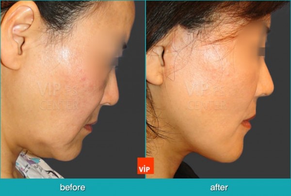 Face Lift - Подтяжка шеи методом High SMAS до и после