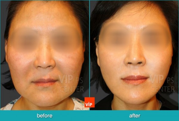 Face Lift - Подтяжка шеи методом High SMAS до и после