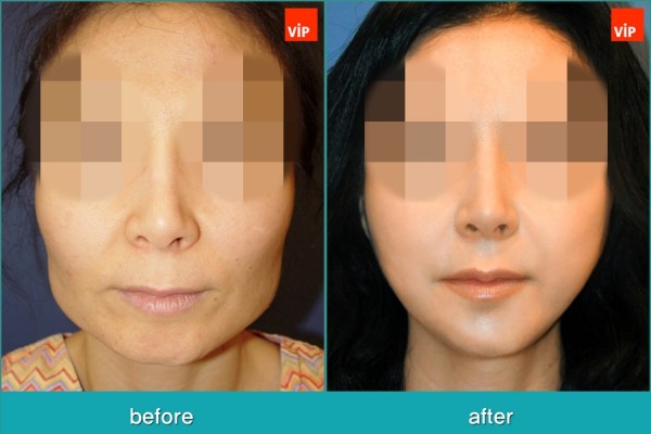 Facial Bone Surgery, Stem Cell Fat Graft - Контурная хирургия лица, V-линия - уменьшение подбородка, липофилинг, уменьшение скул