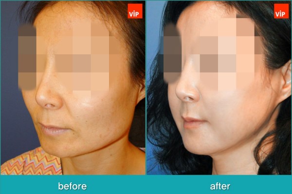 Facial Bone Surgery, Stem Cell Fat Graft - Контурная хирургия лица, V-линия - уменьшение подбородка, липофилинг, уменьшение скул