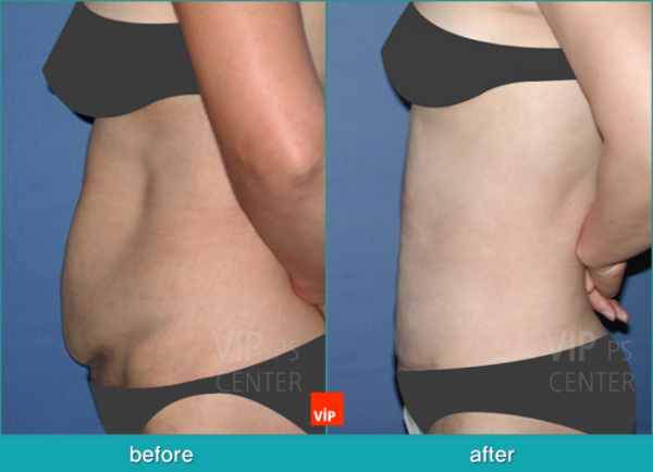 Body Contouring - Контуринг тела - липосакция до после