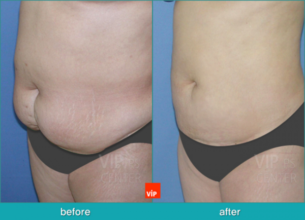 Body Contouring - Контуринг тела - липосакция до после