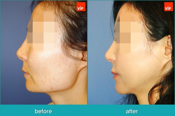 Facial Bone Surgery, Stem Cell Fat Graft - Контурная хирургия лица, V-линия - уменьшение подбородка, липофилинг, уменьшение скул