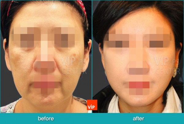 Face Lift - Подтяжка лица, Подтяжка шеи и лица методом High SMAS  с трансплантацией дермы