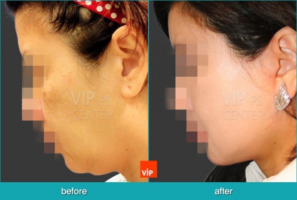 Face Lift - Подтяжка лица, Подтяжка шеи и лица методом High SMAS  с трансплантацией дермы