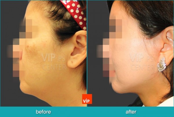 Face Lift - Подтяжка лица, Подтяжка шеи и лица методом High SMAS  с трансплантацией дермы