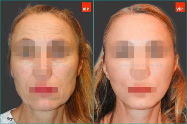 Face Lift - Омолаживающая подтяжка лица и шеи методом High SMAS, эндоскопическая подтяжка, липофилинг