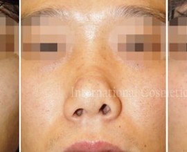 Silicone showing/infection