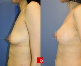 Операция груди, увеличение груди каплевидными имплантатами