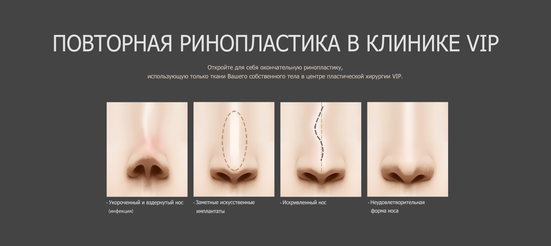 Повторная (ревизионная) ринопластика