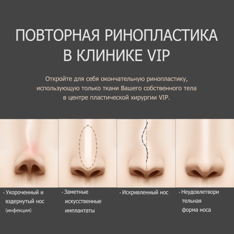Повторная (ревизионная) ринопластика