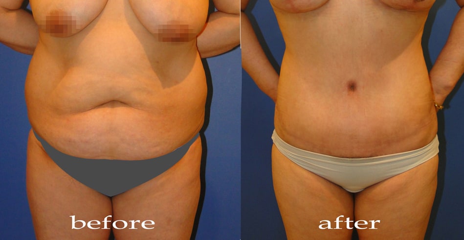 Body Contouring - Увеличение груди до и после