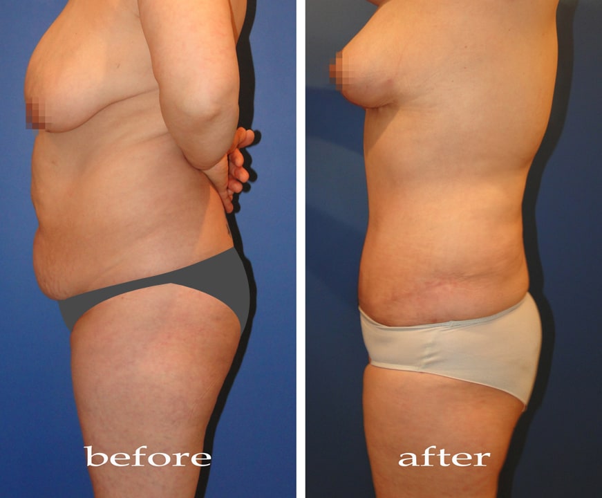 Body Contouring - Увеличение груди до и после