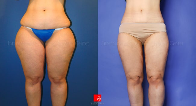 Body Contouring - Контуринг тела | Липосакция тела