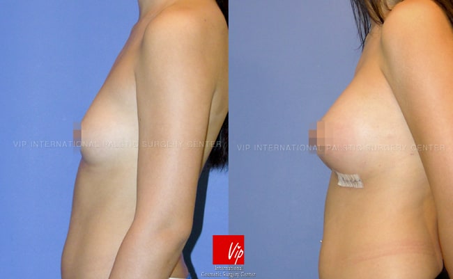 Breast Surgery, Body Contouring - Операция груди, через 7 дней после операции с каплевидными имплантатами