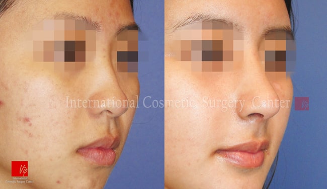 Nose Surgery, Stem Cell Fat Graft - Ринопластика с использованием аутологичного материала и липофилинг