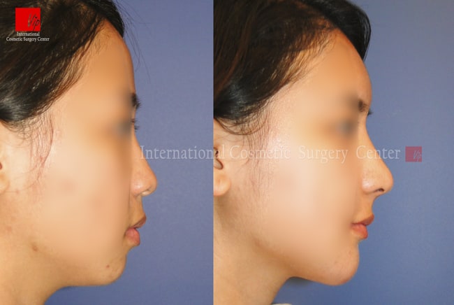 Nose Surgery, Stem Cell Fat Graft - Ринопластика с использованием аутологичного материала и липофилинг