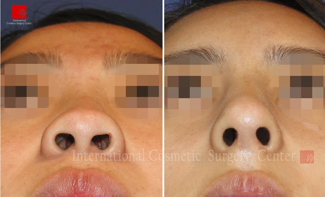 Nose Surgery, Stem Cell Fat Graft - Ринопластика с использованием аутологичного материала и липофилинг