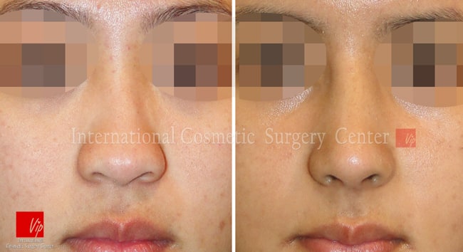 Nose Surgery, Stem Cell Fat Graft - Ринопластика с использованием аутологичного материала и липофилинг
