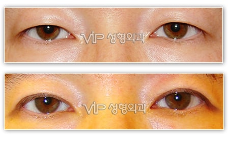 Eye Surgery - Верхняя Блефаропластика