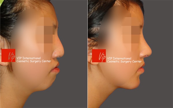 Nose Surgery, Facial Bone Surgery - Коррекция носа с горбинкой (улучшение выступающего рта), Ринопластика с использованием реберного хряща