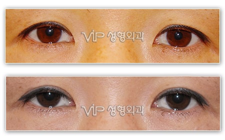 Eye Surgery - Блефаропластика верхнего века
