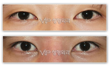 Eye Surgery - Создание "двойного века" (сангапури, сангопуль)