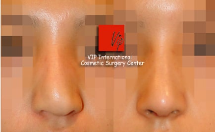 Nose Surgery, Facial Bone Surgery - Коррекция носа с горбинкой (улучшение выступающего рта), Ринопластика с использованием реберного хряща