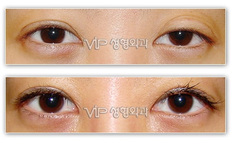 Eye Surgery - Повторная операция по созданию "двойного века" с разрезом