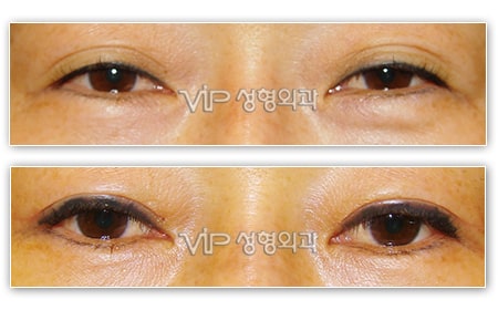 Eye Surgery - Верхняя и нижняя блефаропластика