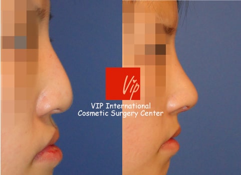 Nose Surgery, Facial Bone Surgery - Коррекция носа с горбинкой (улучшение выступающего рта), Ринопластика с использованием реберного хряща