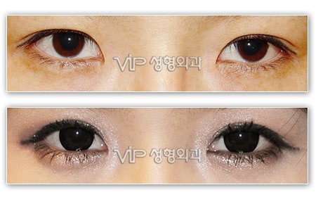 Eye Surgery - Повторная операция по созданию "двойного века" с разрезом
